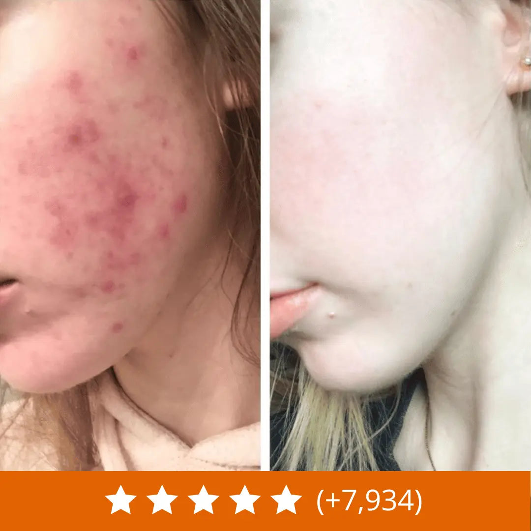 Acnévia™ Nourrit La Peau Pour Rééquilibrer Le Microbiome