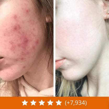 Acnévia™ Nourrit La Peau Pour Rééquilibrer Le Microbiome