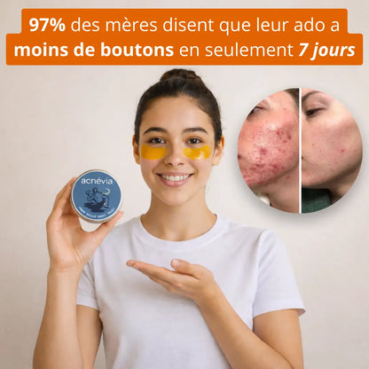 Acnévia™ Nourrit La Peau Pour Rééquilibrer Le Microbiome