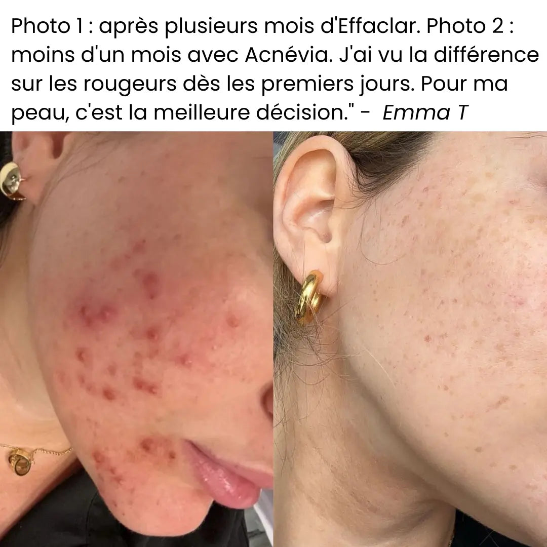 Acnévia™ Nourrit La Peau Pour Rééquilibrer Le Microbiome