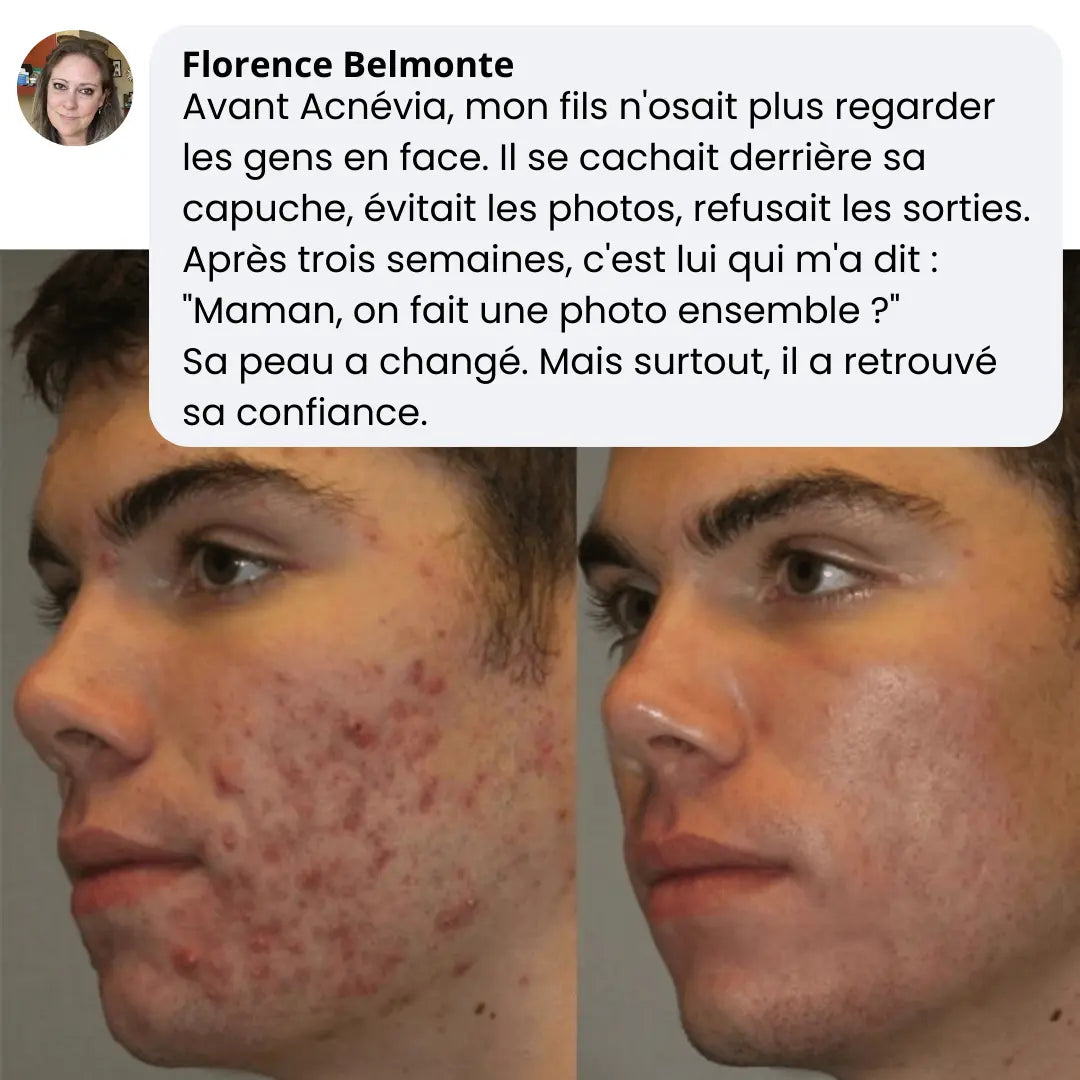Acnévia™ Nourrit La Peau Pour Rééquilibrer Le Microbiome